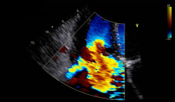 Farbdoppler Mitralinsuffizienz